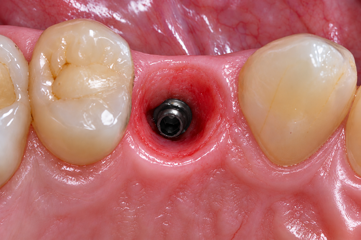 Profil d'émergence : prévenir l'inflammation gingivale autour des couronnes-Dune dental