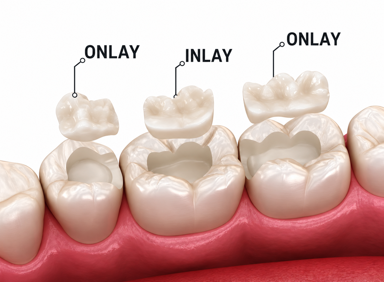 Inlay, onlay, overlay - Dune.dental