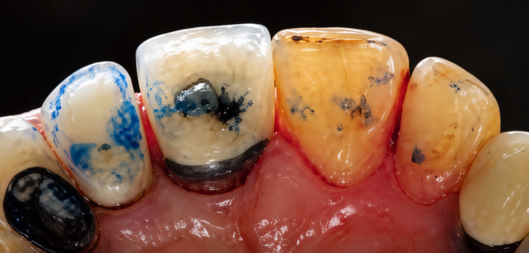 Descellement répété d'une couronne dune dental