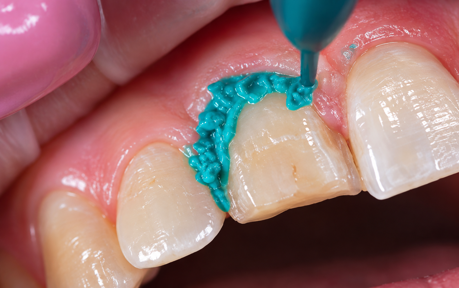 Accès aux limites : maîtriser la gestion du sulcus pour une empreinte lisible dune dental