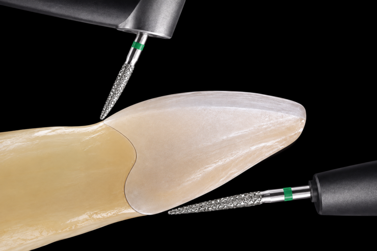 Préparation verticale et BOPT - Dune Dental