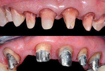 Inlay-core ou tenon fibré : choisir la reconstitution corono-radiculaire